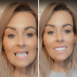 Great Smile Veneers (Upper & Lower)