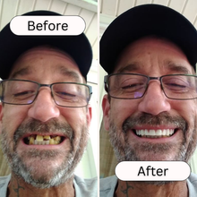 Load image into Gallery viewer, Great Smile Veneers (Upper &amp; Lower)