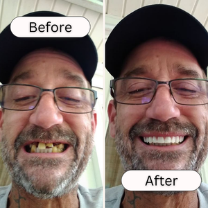 Great Smile Veneers (Upper & Lower)